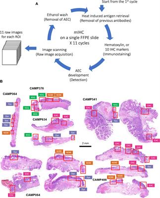 Deciphering the Immune Complexity in Esophageal Adenocarcinoma and Pre-Cancerous Lesions With Sequential Multiplex Immunohistochemistry and Sparse Subspace Clustering Approach